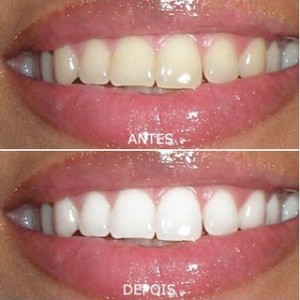Como fazer Clareamento Dental Caseiro 2