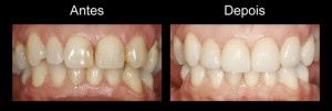 Estética Dental antes e depois do tratamento 3