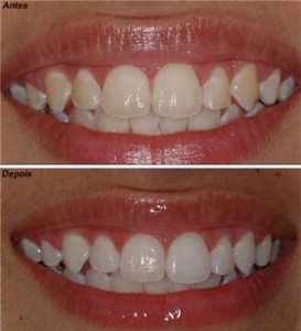 Estética Dental antes e depois do tratamento 4