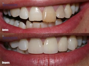 Estética Dental antes e depois do tratamento 5