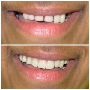 Estética Dental antes e depois do tratamento 6