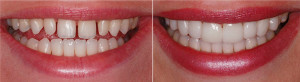 Estética Dental antes e depois do tratamento 7