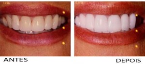 Estética Dental antes e depois do tratamento 8