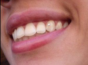 Fotos de piercing feminino no dente 5