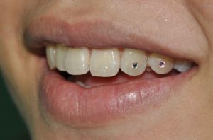 Fotos de piercing feminino no dente 8